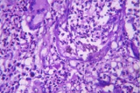 Histopathology showing pigmented hyphae and yeast forms amidst mixed inflammatory infiltrate (H and E, X100)