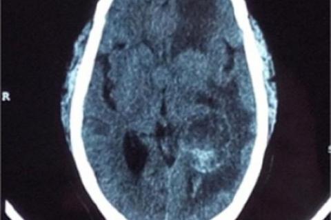  CECT scan axial section showing multiple brain metastases in left frontal