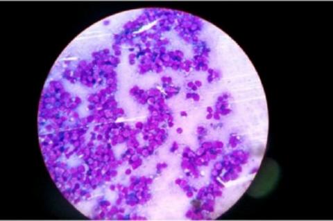 Imprint smear of the mediastinal mass showing mononuclear round cells