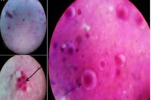 Microscopic picture of pulmonary Fine needle aspiration showing yeast cells visible in 10× magnification