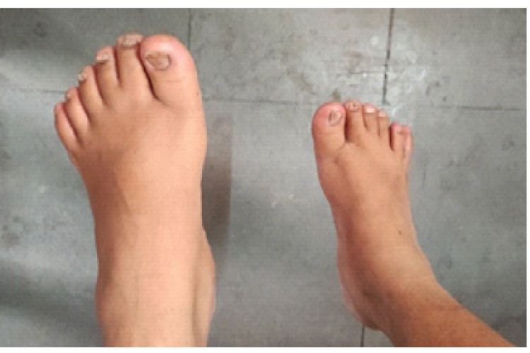 Showing Polydactyly for Both Lower Limbs