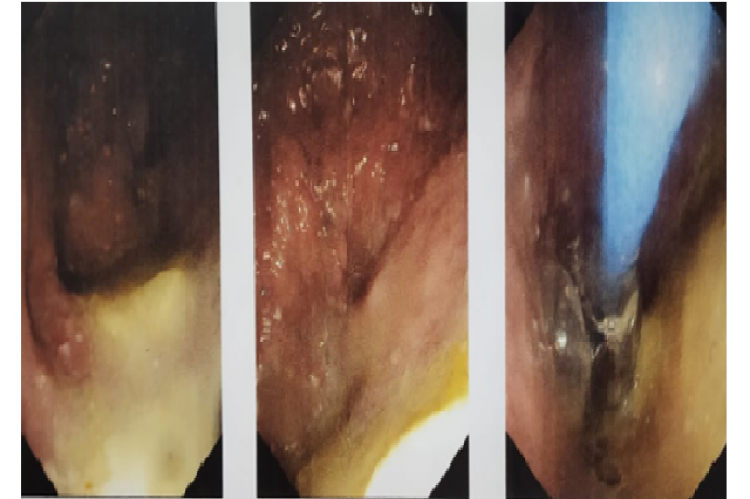 Upper GI Endoscopy showing a roomy, tortuous oesophagus