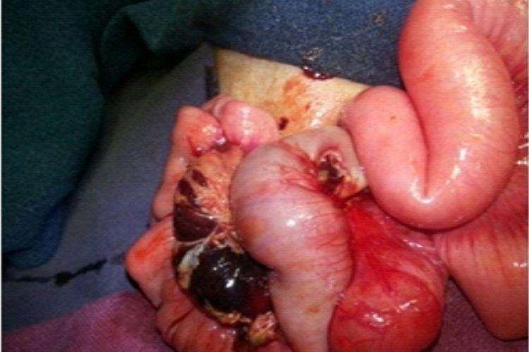 Showing gangrenous bowel 