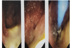 Upper GI Endoscopy showing a roomy, tortuous oesophagus